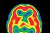 Healthy brain scan using technetium-99m. Here the brain activity is colour-coded, from red (most active) through yellow to green and blue (least active).