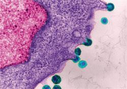 Mature HIV virus infection showing budding release of HIV in human lymphatic tissue