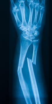 An xray of a broken bone