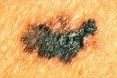 A malignant melanoma blemish