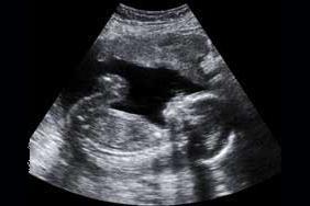 Ultrasound of a baby
