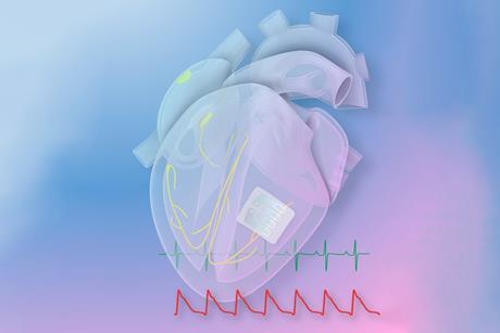 A transparent diagram of a heart showing a small white square with a metallic pattern on and yellow wires leading to the rest of the heart