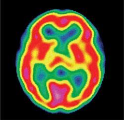Healthy brain scan using technetium-99m. Here the brain activity is colour-coded, from red (most active) through yellow to green and blue (least active).