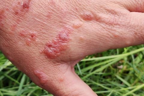 Close up on a hand that has red swollen clusters of blisters
