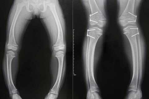 An x-ray of a child with bowed legs