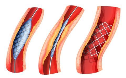 An image showing a heart stent changing shape